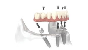 Perfect Smile Implant Bridge on Multi-unit Abutments